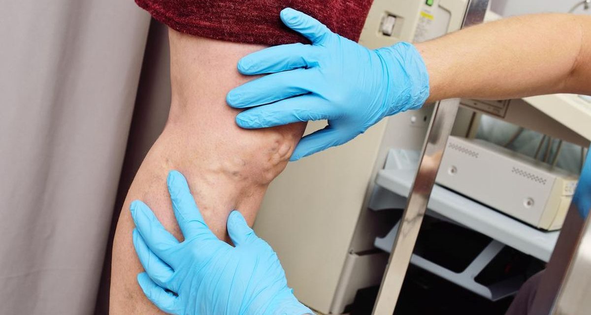 Varises Tak Pandang Gender, Ini Penyebab Pada Pria Dan Wanita