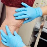 Varises Tak Pandang Gender, Ini Penyebab Pada Pria Dan Wanita