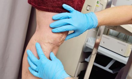 Varises Tak Pandang Gender, Ini Penyebab Pada Pria Dan Wanita