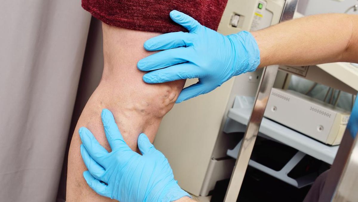 Varises Tak Pandang Gender