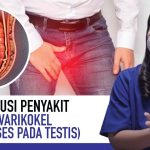 Penyakit Varikokel Cukup Berbahaya, Kenali Beberapa Gejalanya
